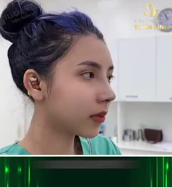 Chỉ sau 90 phút đã thay đổi hoàn toàn, dáng mũi được ''lột xác'' đẹp thanh tú: